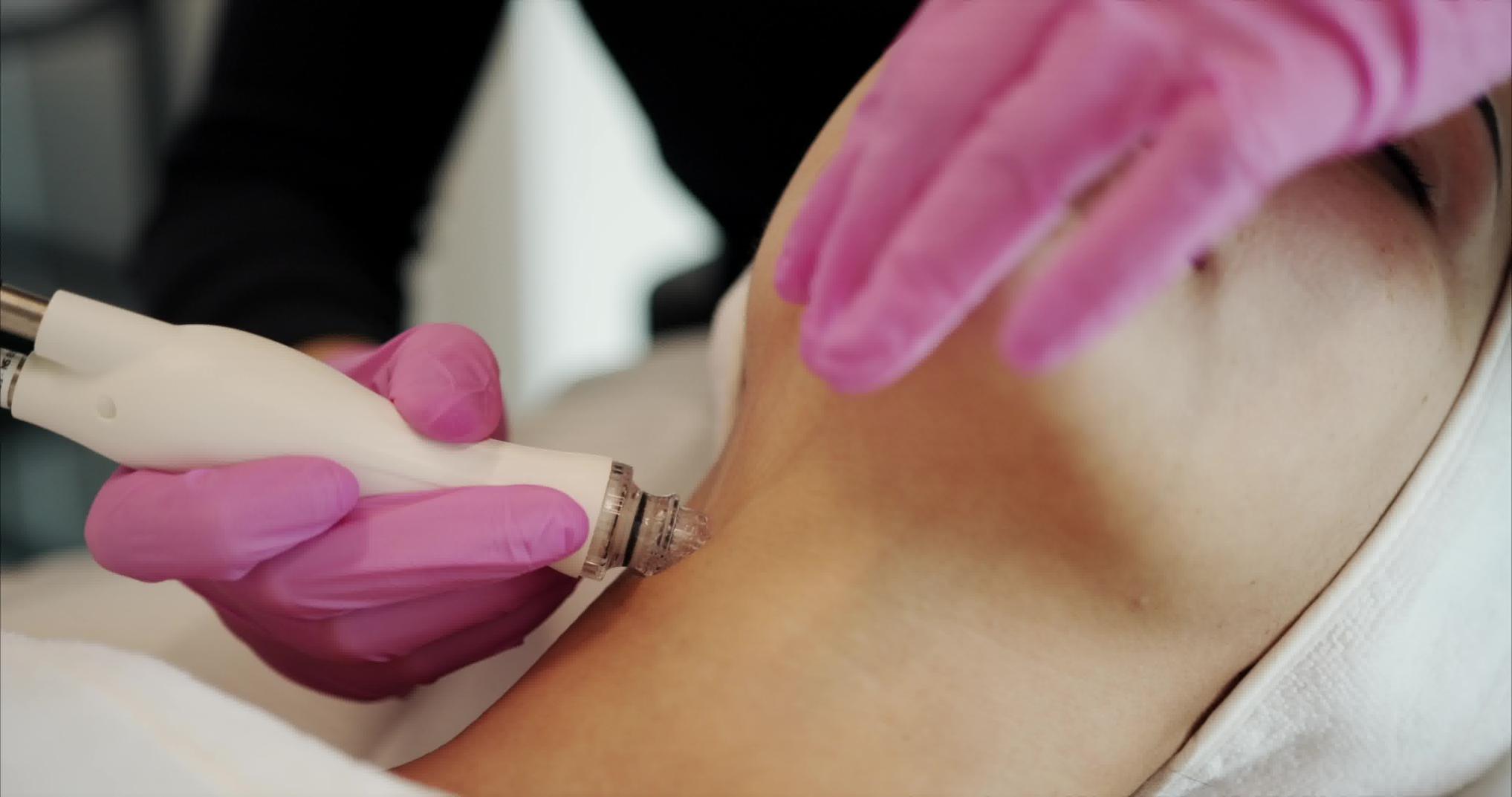Dermabrasion treatment — New Age Spa
