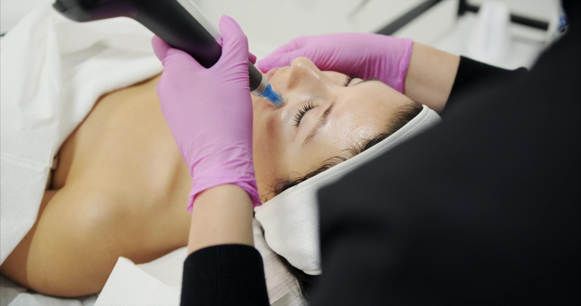 Microneedling with the Dermapen DP4 in progress at New Age Spa, Montreal — around the smile-line area