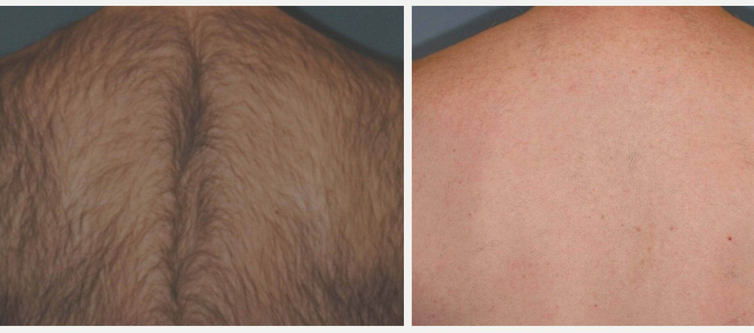 Laser hair removal before and after result after 4 treatments — Candela GentleMax Pro