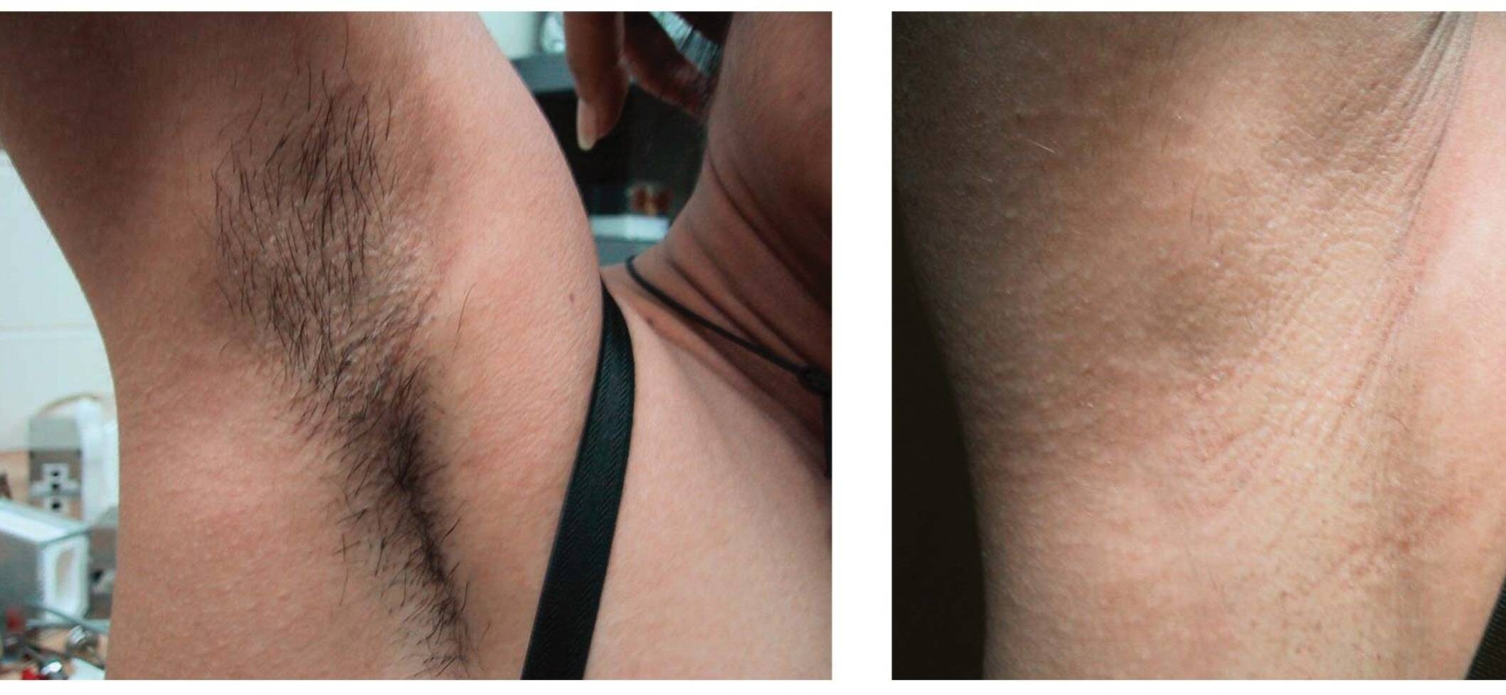 Laser Hair Removal Montreal & Laval | Painless & Permanent