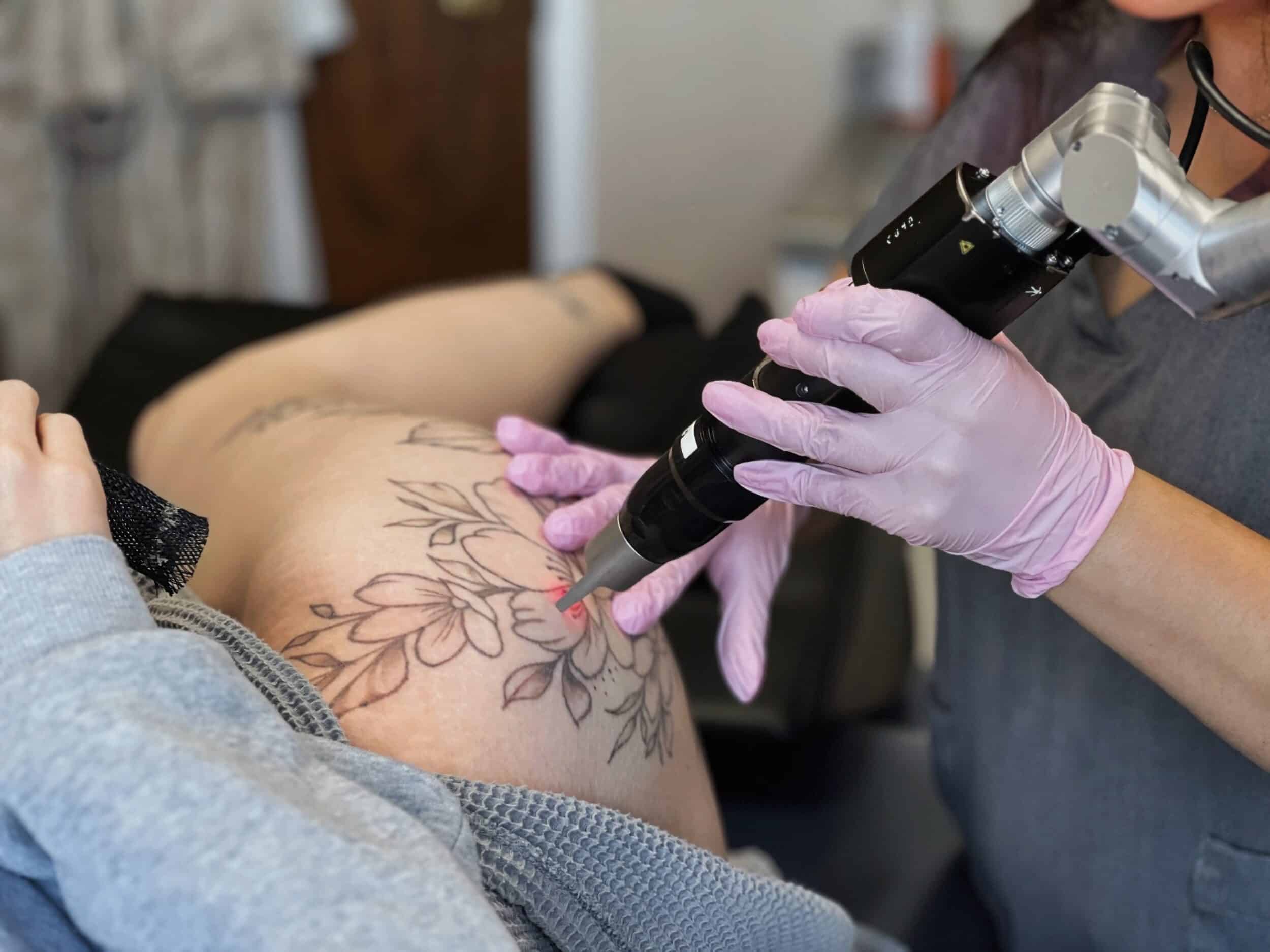 Best Laser Tattoo Removal Service in Montreal - New Age Spa