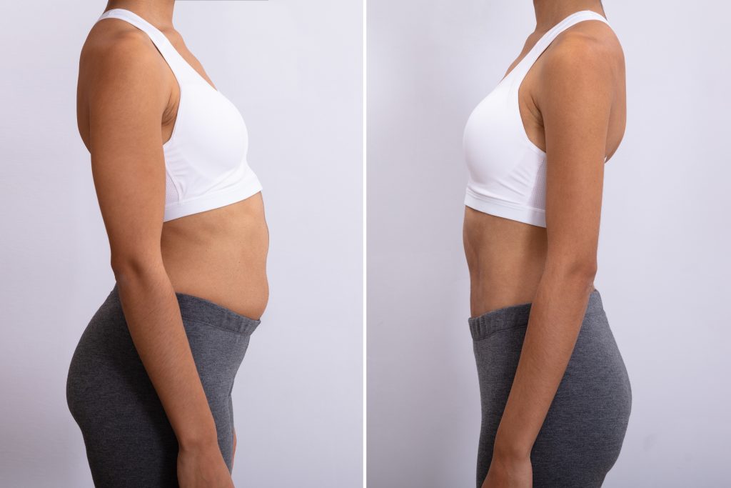 Slimwave EMS body sculpting result — New Age Spa