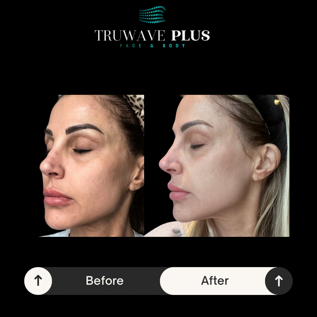 Before-and-after appearance of a firmer jawline and more lifted face after a series of TruWave™ EMS facial sessions — individual results vary