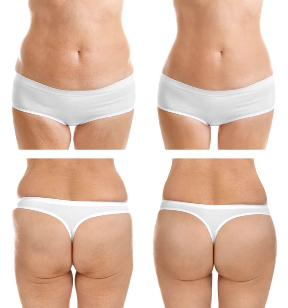 Slimwave body transformation — New Age Spa